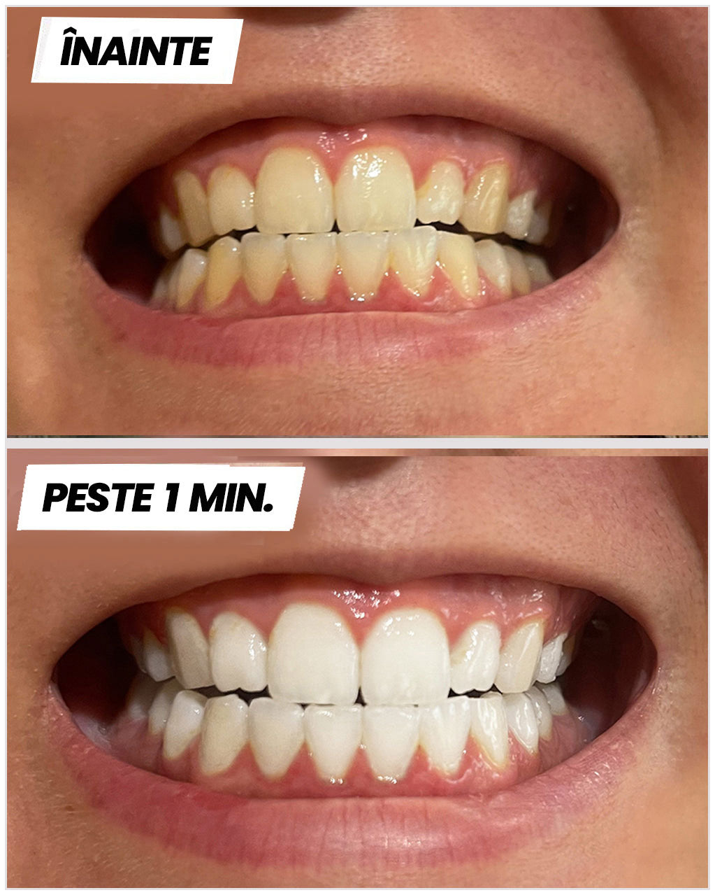 Benzi pentru Albirea dinților™ - clicksmile.net 