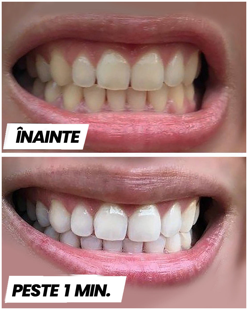 Benzi pentru Albirea dinților™ - clicksmile.net 