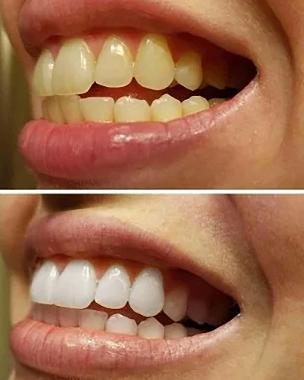 Pastă pentru albirea dinților™ - clicksmile.net 